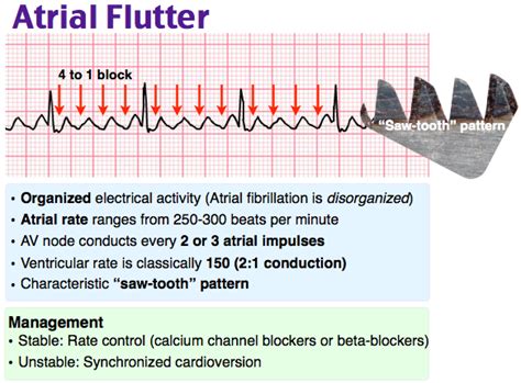 Left atrial flutter symptoms - notesmine