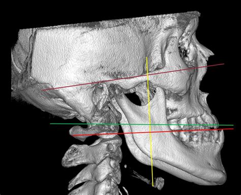 Reference lines: Brown line: Frankfort horizontal plane; Green line ...