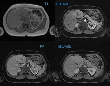 Focal nodular hyperplasia | Radiology Reference Article | Radiopaedia.org