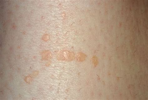 Pin on Blemishes and Lesions