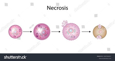 Necrosis, Pathologic Cell Death, Death of the - Royalty Free Stock Vector 2367550417 - Avopix.com