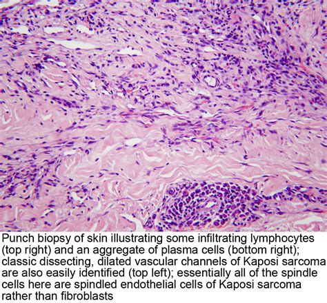 Pathology Outlines - Kaposi sarcoma