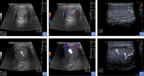 Multimodal ultrasound diagnosis of epididymo‐orchitis with secondary ...