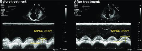 Echocardiography: apical four-chamber, M-mode TAPSE evaluation. Left... | Download Scientific ...