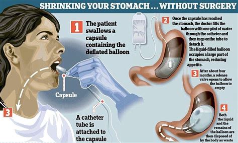 Pin on Bariatric