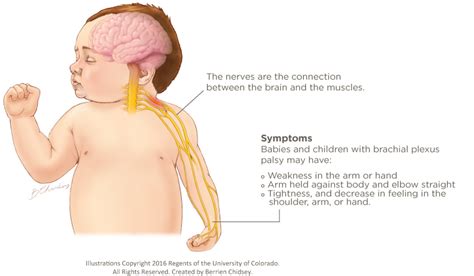 Brachial Plexus Injury | Children's Hospital Colorado