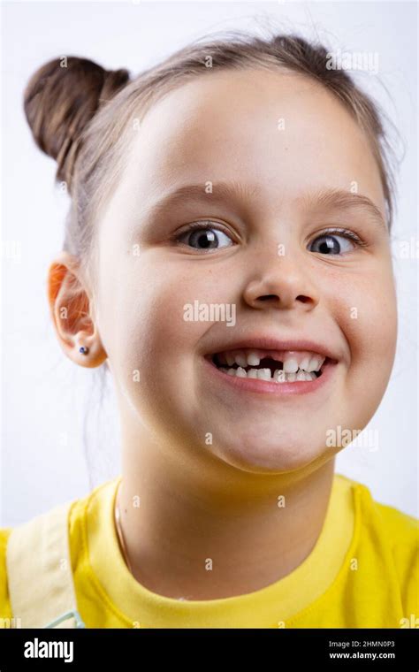 Little girl face smiling with opened mouth showing missing front milk tooth in yellow t-shirt on ...