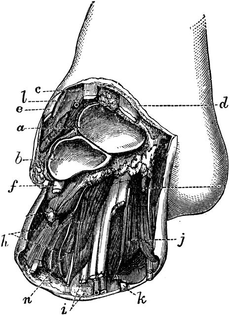 Chopart's Amputation at the Mediotarsal Joint | ClipArt ETC