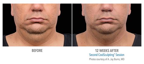 CoolSculpting for Chin, Neck and Jawline - New Radiance Cosmetic ...