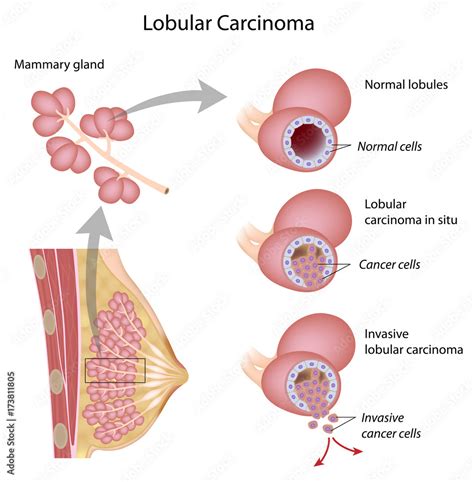 Lobular Carcinoma In Situ (LCIS) Symptoms Causes Mayo