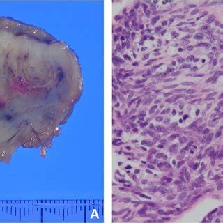 Gross pathology of cardiac spindle cell sarcoma (a) and histopathology... | Download Scientific ...