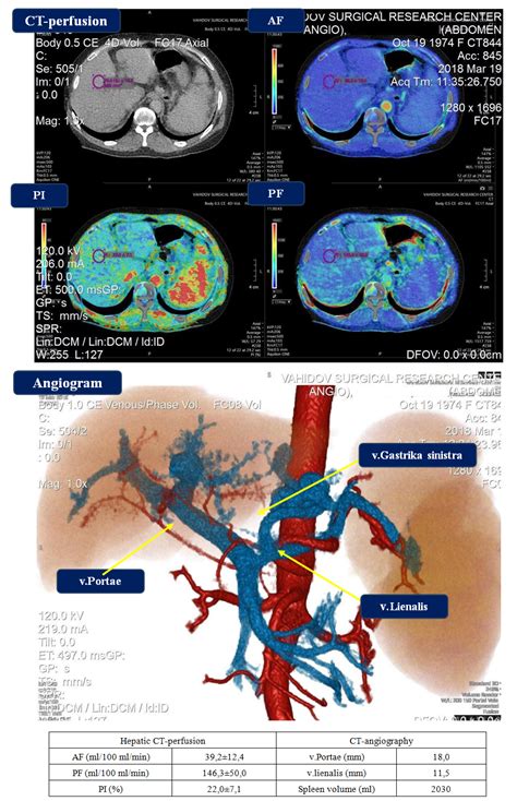 The Features of Liver Perfusion in Various Hepatic Diseases and Portal Hypertension According to ...