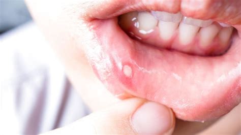 Aphthous stomatitis in children and adults: types, symptoms and treatment