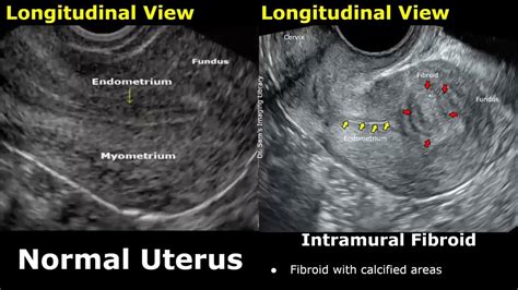 Uterus Ultrasound Normal Vs Intramural Fibroid Images | Uterine ...