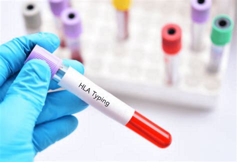 What Is HLA Typing and How Is It Performed? | Cytologics