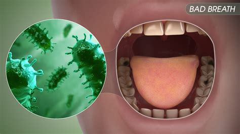 Bad Breath: Symptoms, Causes, and Treatment - Scientific Animations