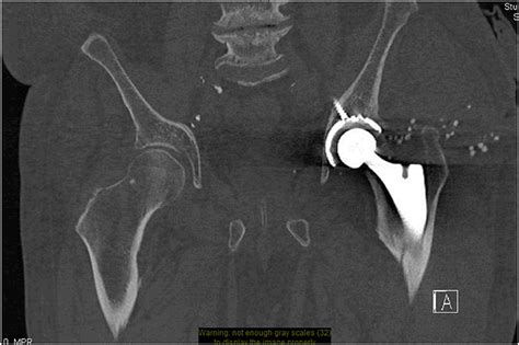 Frontiers | Radiological Imaging Evaluation of the Failing Total Hip ...