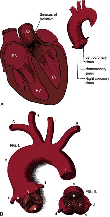 Sinus Of Valsalva Aneurysm - slidesharetrick