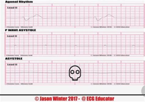 Agonal Rhythm