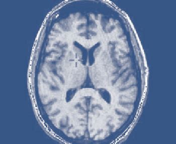 ALCOHOL'S DAMAGING EFFECTS ON THE BRAIN