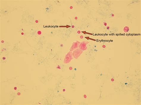 urine microscopic bacteria