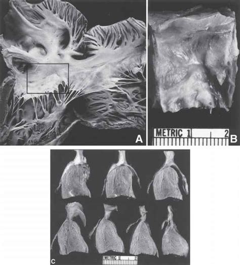 Dissection Methods Of The Heart Specimen Preparation