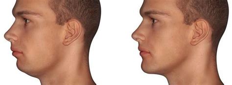 Chiseled & Masculine Jawline | Male Chin Reduction | Torrance, CA