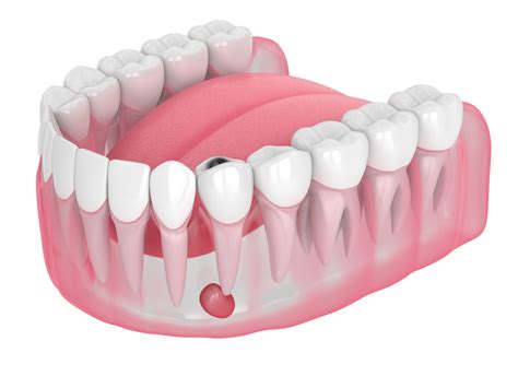 How Long Do Tooth Abscesses Last?