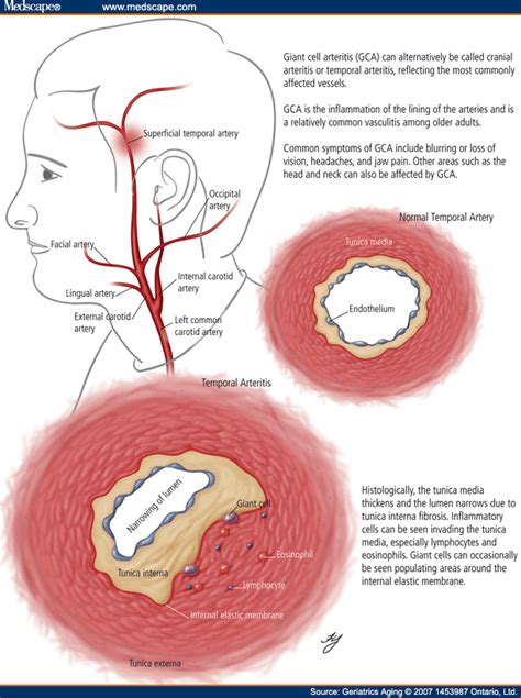 Russell's Blog: cranial arteritis