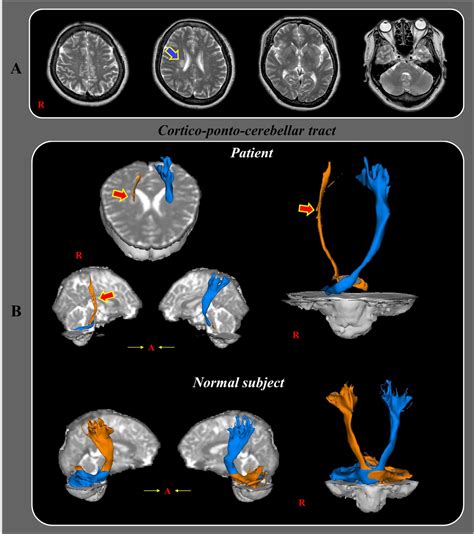 Ataxic hemiparesis after corona radiata infarct: Diffusion tensor imaging correlation of ...