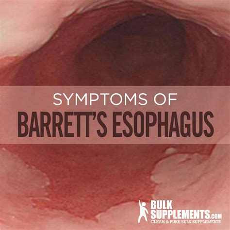 Barrett's Esophagus: Symptoms, Causes & Treatment