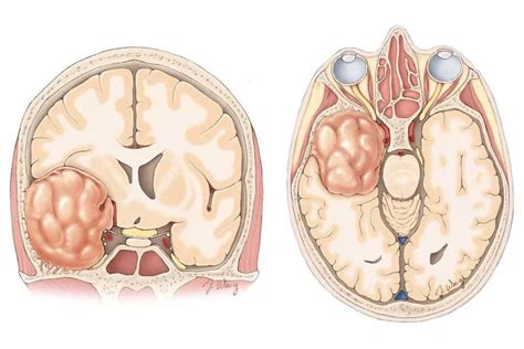 Olfactory Groove Meningioma | Case Study - Dr Sambuddha Dhar - Dr. Sambuddha Dhar | Best ...