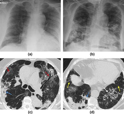 (a) Baseline chest X-ray and (b) two-week follow-up chest X-ray of an ...