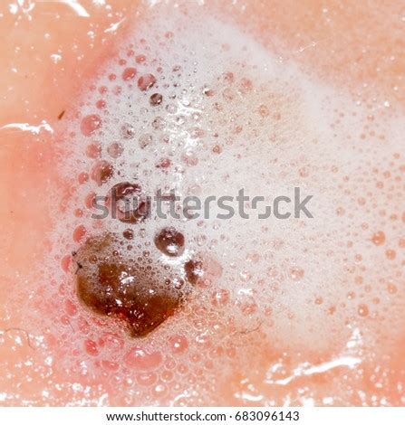 Wound On Human Skin Hydrogen Peroxide Stock Photo 683096143 - Shutterstock