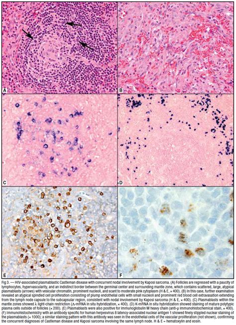 Diagnosis and Management of Castleman Disease - Cancer Therapy Advisor