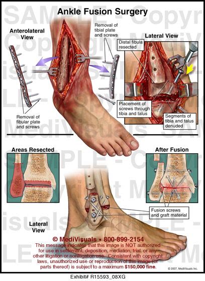 Ankle Fusion Surgery MediVisuals Medical Illustration