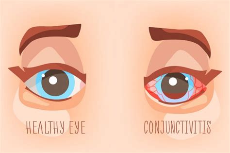 Viral Eye Infection: Types, Symptoms, Treatment | STD.GOV Blog