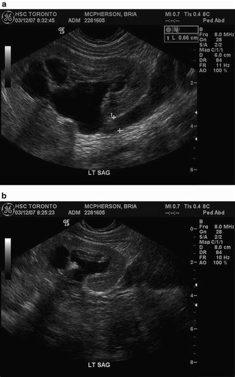 Ectopic Ureter | SpringerLink