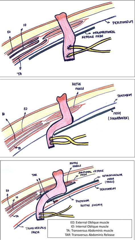 Illustrations of various mesh positions in ileal conduit parastomal ...