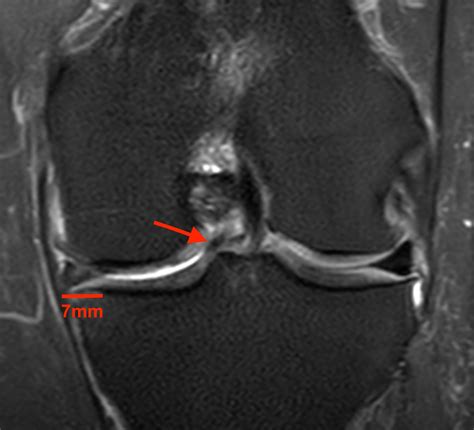 Bucket-handle Tear of the Meniscus | Radsource