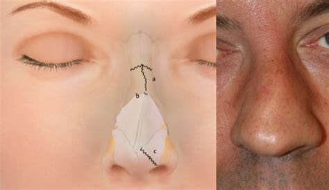 Nasal Trauma Rhinoplasty Los Angeles Nose Injury Surgeon