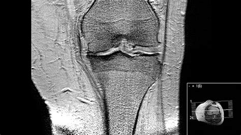 Mri Images Of Problem Knee