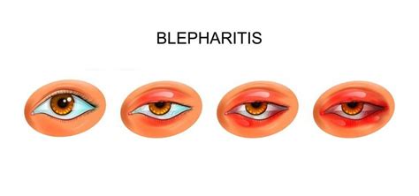 I Cured My Blepharitis in 3 Easy Ways