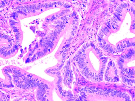 Molecular pathology of endometrial carcinoma: practical aspects from ...