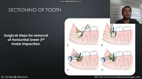 Management of Impacted Lower 3rd Molars - Part II - YouTube