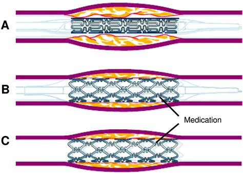 How long does a heart stent last? Do they need to be replaced? | Cardiac Health