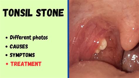 Tonsil Stone