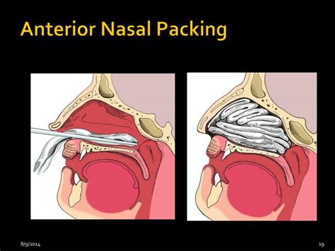 PPT - epistaxis PowerPoint Presentation - ID:3096374