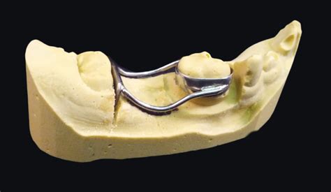 Laser Welded Distal Shoe @ OrthoPrime