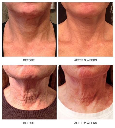 Look at these results after just a few weeks of using Replenix Neckletage, neck cream! | Neck ...